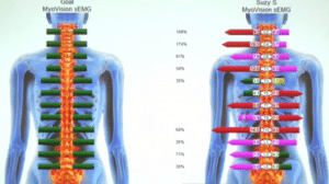 myovision example